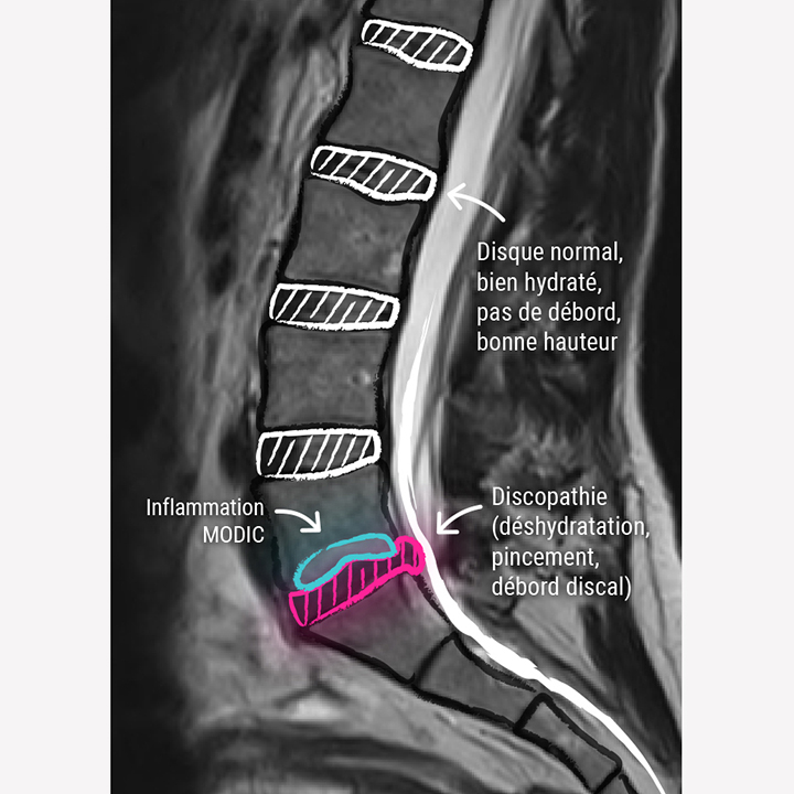 Discopathie lombaire - CCV Montpellier