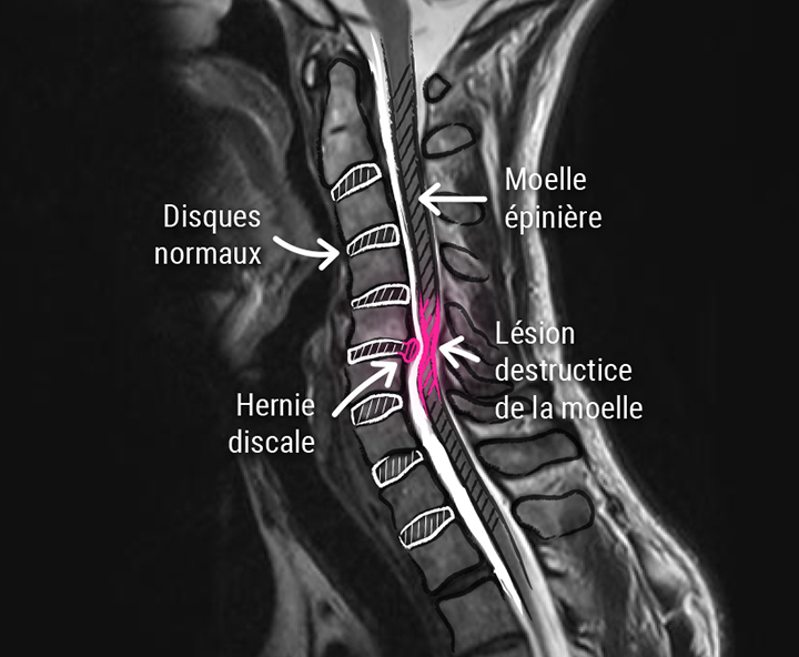 Hernie discale cervicale - CCV Montpellier