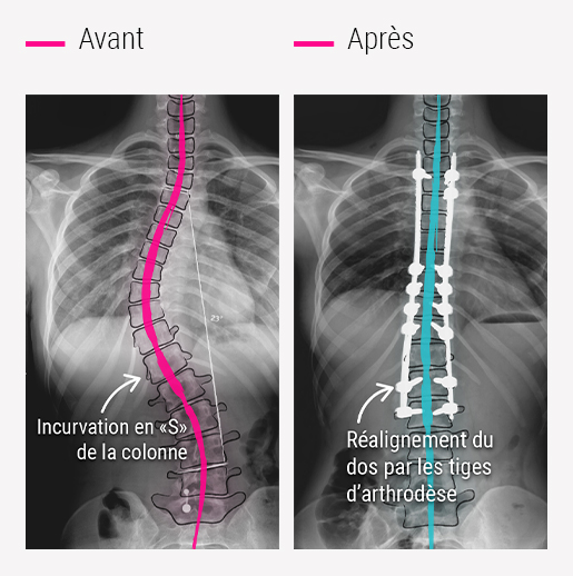 Chirurgie de la scoliose - CCV Montpellier