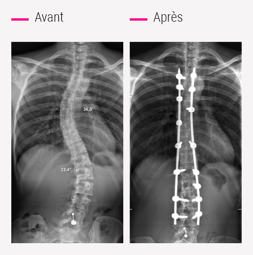 Chirurgie de la scoliose - CCV Montpellier