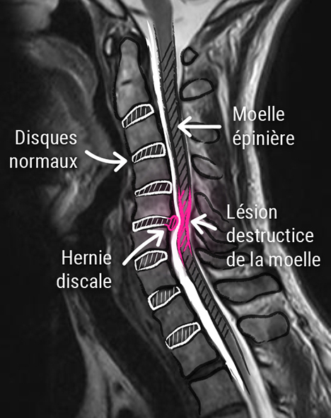 Chirurgie cervicale - CCV Montpellier