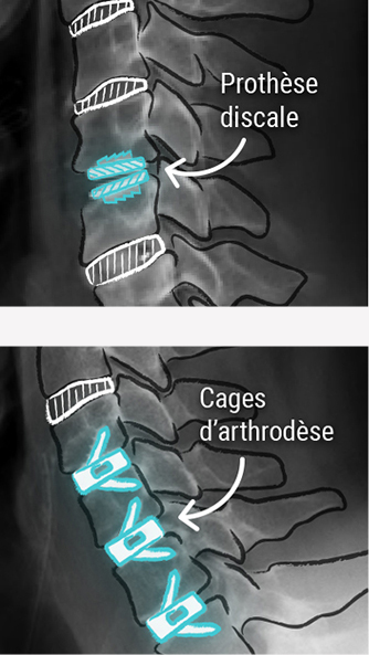 Chirurgie cervicale - CCV Montpellier