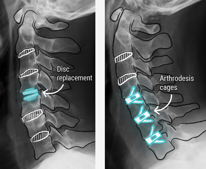 herniated disc x ray