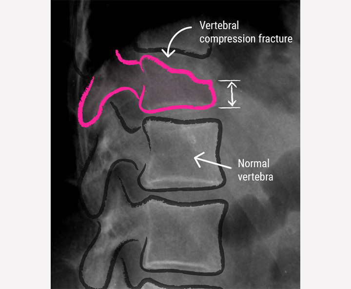 Vertebral Compression - CCV Montpellier