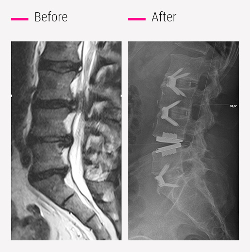 4. Traumatic sequelae with thoracic spine deformity